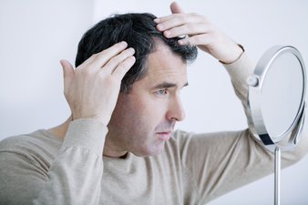 Alopecia